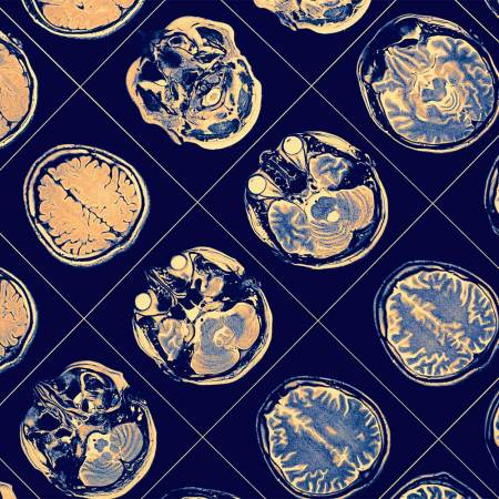 Images of a human brain. A new drug from Eli Lilly has been endorsed for approval by an FDA advisory panel.